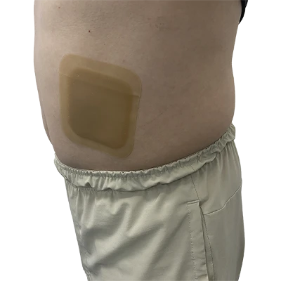 hydrocolloid dressing hydrocolloid dressing
